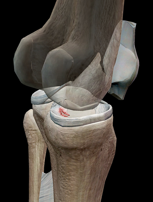 Torn medial meniscus discount